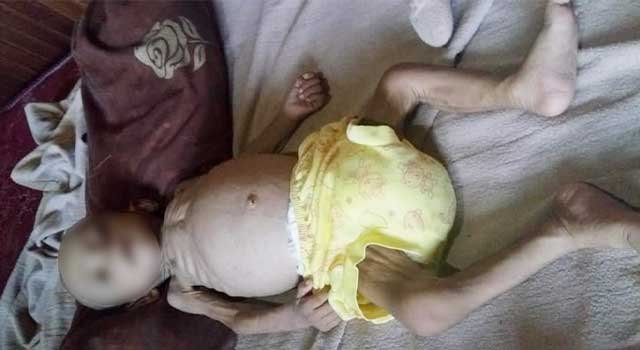 Berawal dari Pembengkakan, Bayi Bernama Dilson Dinyatakan Mengidap Gizi Buruk