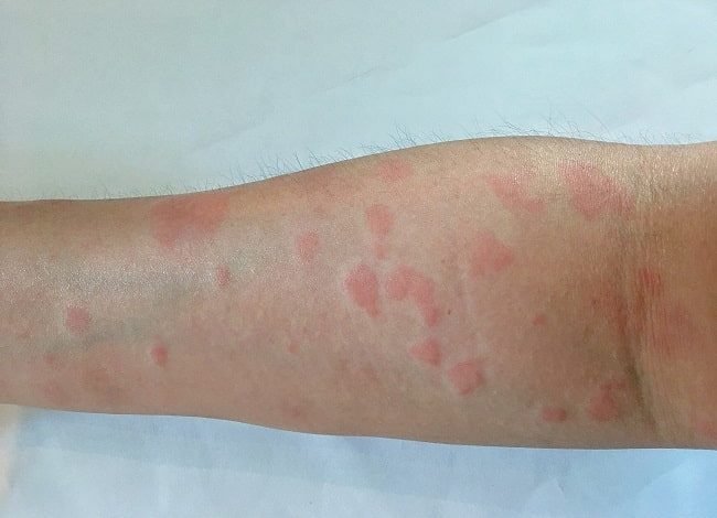 Memahami Lupus: Penyakit Seribu Wajah yang Diwaspadai pada Hari Lupus Sedunia